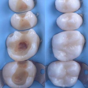 Пломбування зубів