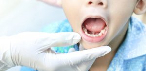 Лазерна пластика вуздечок губ і язика